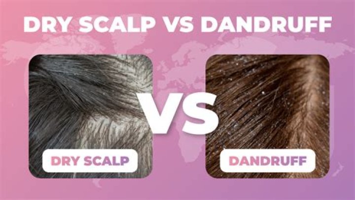 Dry Scalp vs Dandruff | Hollywoodlife Reviews – Hollywood Life