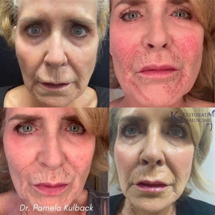 Paulina Porizkova, 55, Reveals Red & Blotchy Face After Plasma Pen Treatment: ‘Lookin’ Freaky’